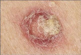 皮肤癌图片 初期,皮肤癌图片对照大全 查看图片_竞价网