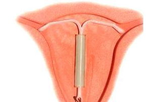 避孕环是什么原理避孕环是什么东西