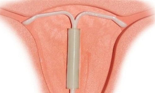 避孕环是什么原理避孕环是什么东西