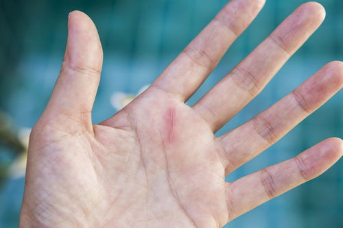 我的右手虎口处肌肉频繁跳动,请问这是病吗