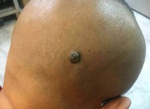 头顶上长小肉猴命运如何