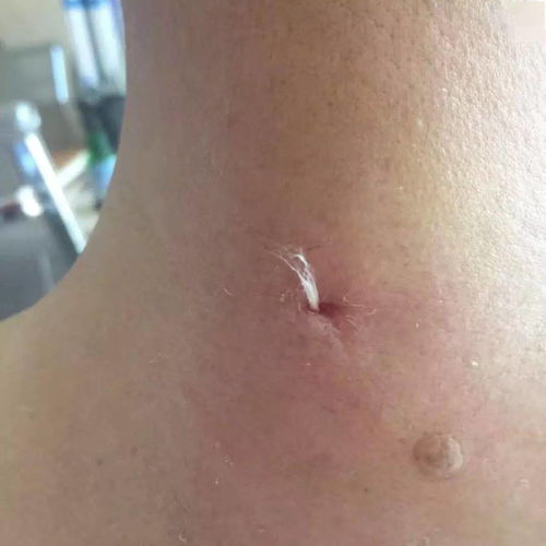 羊毛疔是怎么形成的?