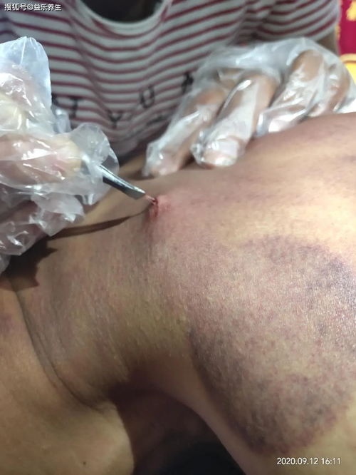 羊毛疔挑之前的图片羊毛疔挑出来的图片