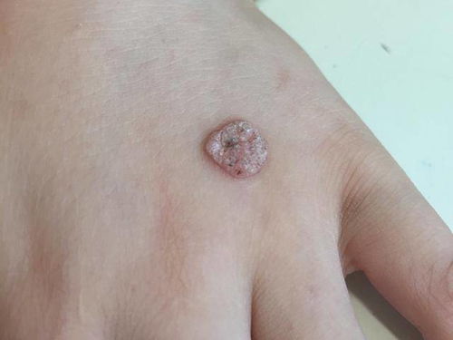 瘊子的位置与命运解析背上瘊子的位置与命运解析