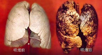 吸烟10年的肺真实图片图片