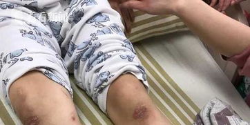 打脚底打脚底板有危害吗