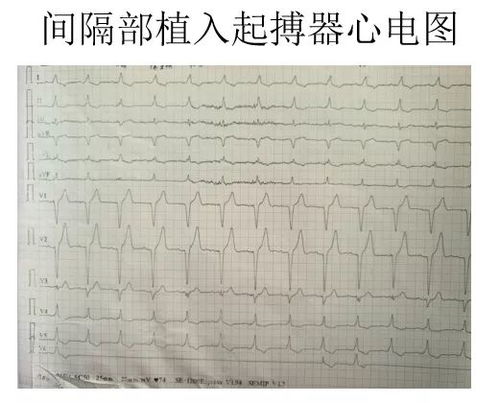 koch三角的概念.冠状动脉的主要分支有哪些