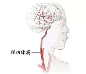 颈动脉窦位置颈动脉窦位置图