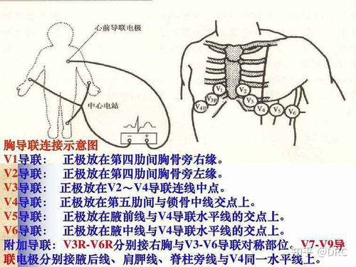 在行常规心电图检查时,通常只安放4个肢体导联电极和