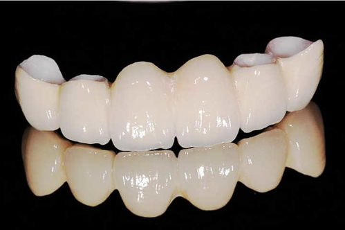 普通烤瓷牙大概要多少钱