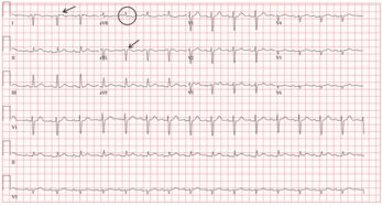 十二导联心电图位置图十八导联心电图位置图怎么连