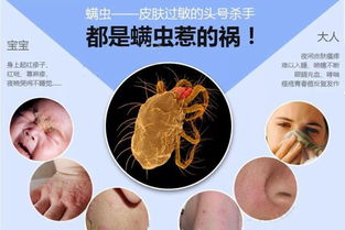 怎么除螨虫最有效方法是什么?求分享