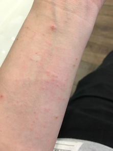 疥疮的最初症状图片