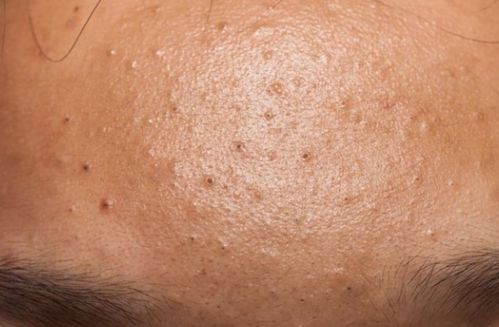 开口粉刺就是黑头白头,把毛孔撑成一个个小洞洞,可以挤出来的就是开口