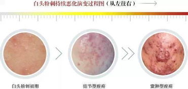 粉刺图片?粉刺是什么样的?