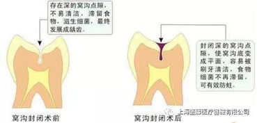 儿童真的有必要做窝沟封闭吗?有什么危害?