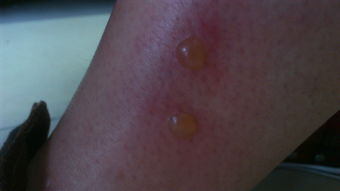 脚上长水泡怎么办?