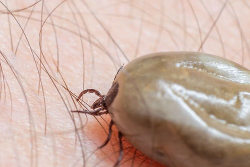 怎样才能快速去除头上的虱子