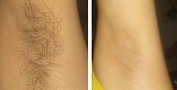 冰点脱毛还会长出来吗冰点脱毛脱了还会长吗