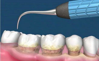 好多人都为了牙白去洗牙,那么洗牙对牙齿到底好不好?