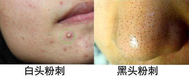 痘痘和粉刺的区别