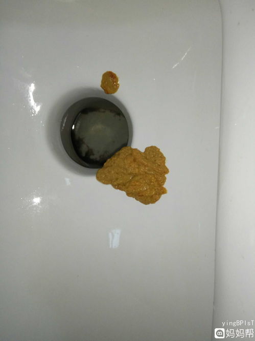 大便稀首先要到医院检查是否为慢性结肠炎引起,另外也可能与药物,情绪