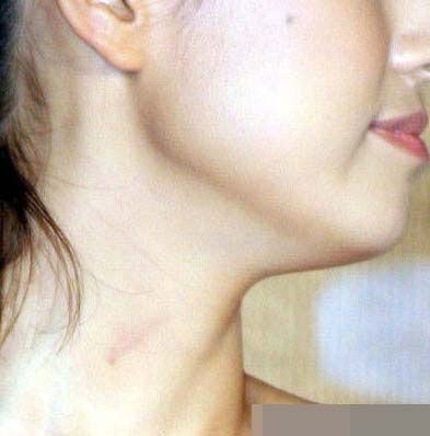 脖子上脖子上长痘痘什么原因