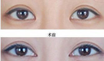 目前开眼角什么地方好?