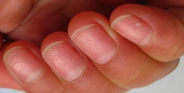 病情分析:您好,指甲上有横纹,可能是有心脏病,机体缺钙,贫血或营养