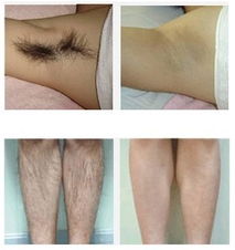 怎样去除身上的汗毛