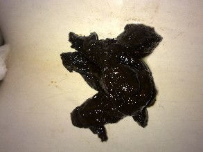 黑色大便的原因有哪些人体排出的大便是黑的是什么原因