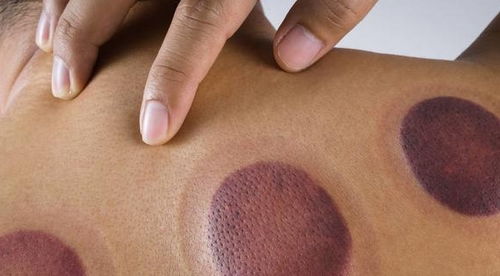 拔罐颜色紫黑代表什么拔罐颜色紫黑代表什么用