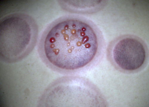 拔罐颜色紫黑代表什么拔罐颜色紫黑代表什么用