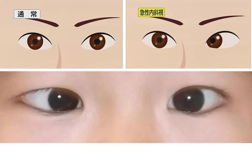 正常瞳孔和瞳孔放大图正常瞳孔和瞳孔放大图片