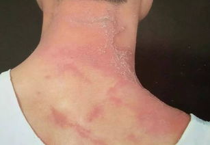 隐翅虫咬人后图片(隐翅虫咬人后图片 治疗方法)_竞价网