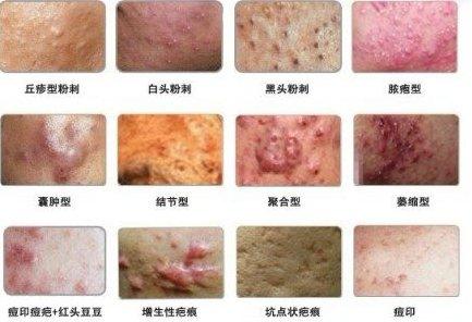 粉刺长什么样子