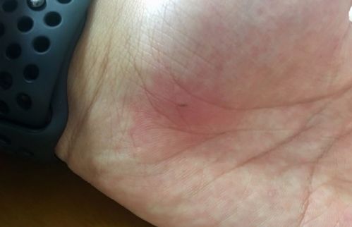 手上扎刺怎么能快速出来(手上扎刺怎么能快速出来妙招)_竞价网