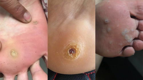 鸡眼和跖疣的区别图鸡眼和跖疣的区别图图片