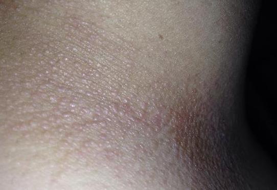 为疣,它其实就是一种很常见的皮肤问题,不会对我们的身体健康造成伤害