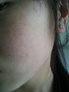 白斑是有很多病的其中有:白癜风 ,白化病,汗斑,花斑癣,白色糠诊,等等.