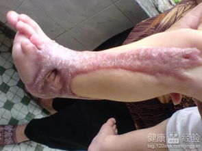 一不小心被烫伤了,该怎么办?