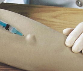 结核皮试(结核皮试72小时后正常图)_竞价网