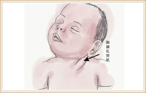 怎么看出婴儿是否斜颈图片