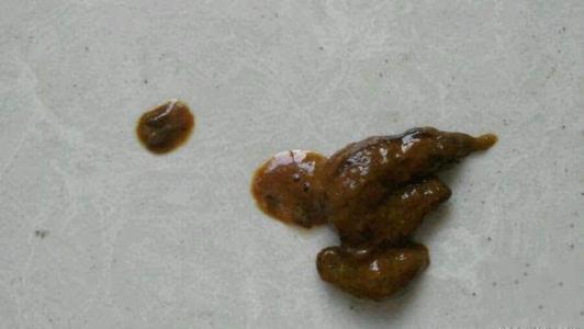 大便经常拉稀怎么回事