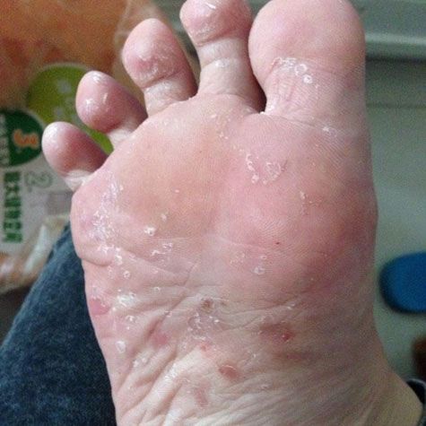 香港脚怎么治最好最快