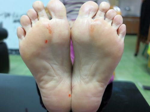 为什么脚臭要叫香港脚图片