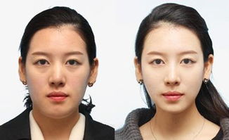 怎么样去掉二下巴?