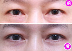 眼皮抽脂多少钱