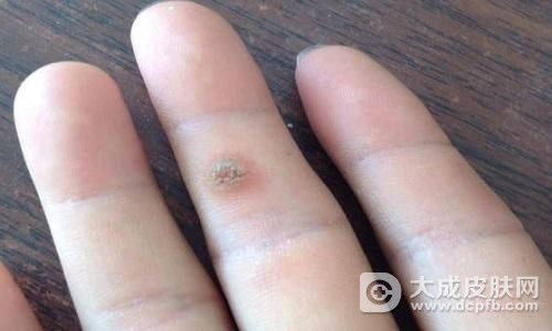手上长瘊子怎么去除(手上长瘊子怎么去除图片)