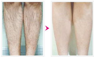 腿部激光脱毛价格